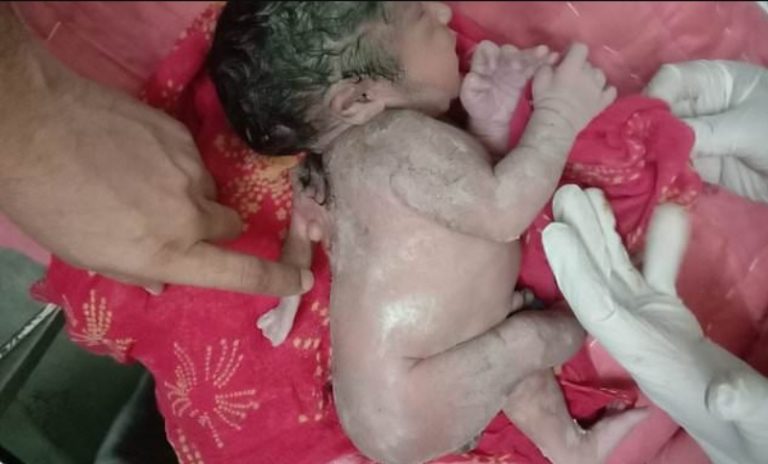 Ινδία: Συγκλονιστικό βίντεο – Γεννήθηκε μωρό με τρία χέρια