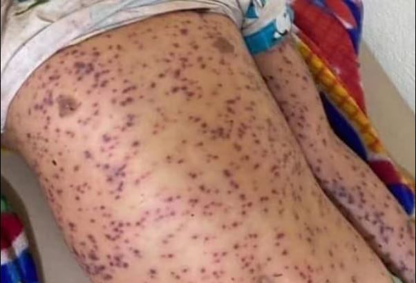 Έξι νεκροί από τσιμπήματα μελισσών όταν λεωφορείο έπεσε σε μελίσσια στη Νικαράγουα