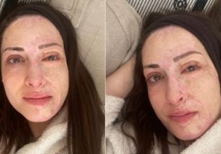 Η ανατριχιαστική φωτογραφία της Ιωάννας Παλιοσπύρου για τα τρία χρόνια από την επίθεση με βιτριόλι [Προσοχή, σκληρές εικόνες]