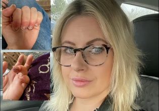 Αλλεργία στο τζελ νυχιών: Έκανε μανικιούρ και μετά βίας μπορεί να κουνήσει τα χέρια της