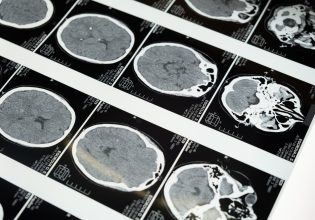 Η κόρη μου διαγνώστηκε με άνοια και είναι μόλις 19 – «Νιώθω απλώς χαμένη»