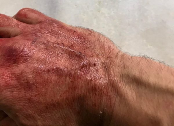 ΣΥΡΙΖΑ: Επίθεση από χρυσαυγίτες σε μέλος του κόμματος στο Ζεφύρι