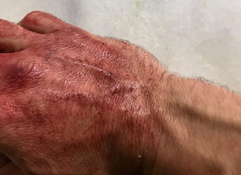 ΣΥΡΙΖΑ: Επίθεση από χρυσαυγίτες σε μέλος του κόμματος στο Ζεφύρι