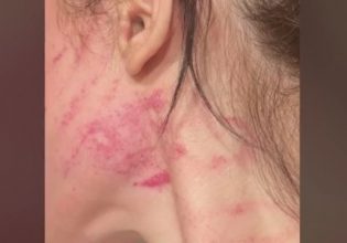 Ενδοοικογενειακή βία: Ζήτησε από το σύντροφό της να χωρίσουν και την έσπασε στο ξύλο