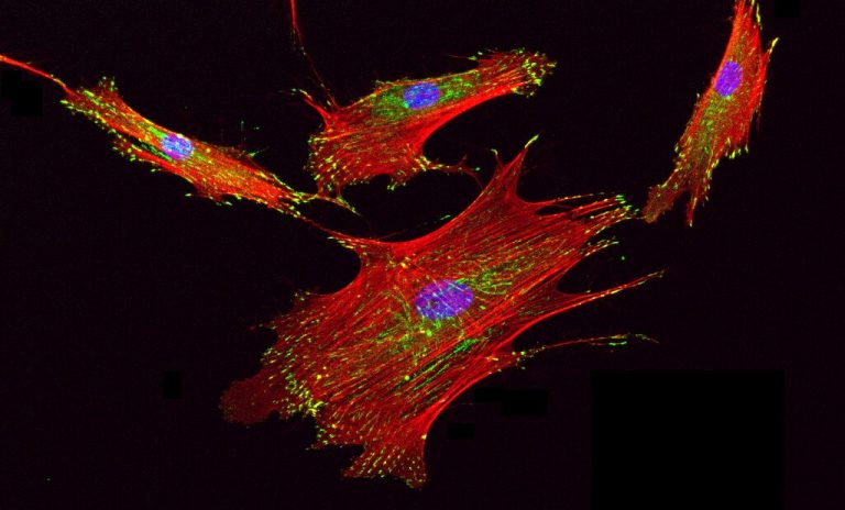 Βλαστικά κύτταρα «εξαφάνισαν» τις επιληπτικές κρίσεις σε δύο ασθενείς