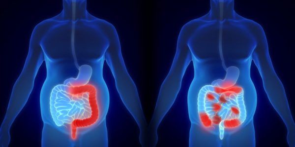 Άγχος και κατάθλιψη φέρνουν η νόσος Crohn και η ελκώδης κολίτιδα