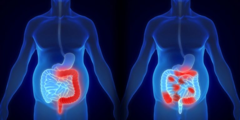 Άγχος και κατάθλιψη φέρνουν η νόσος Crohn και η ελκώδης κολίτιδα