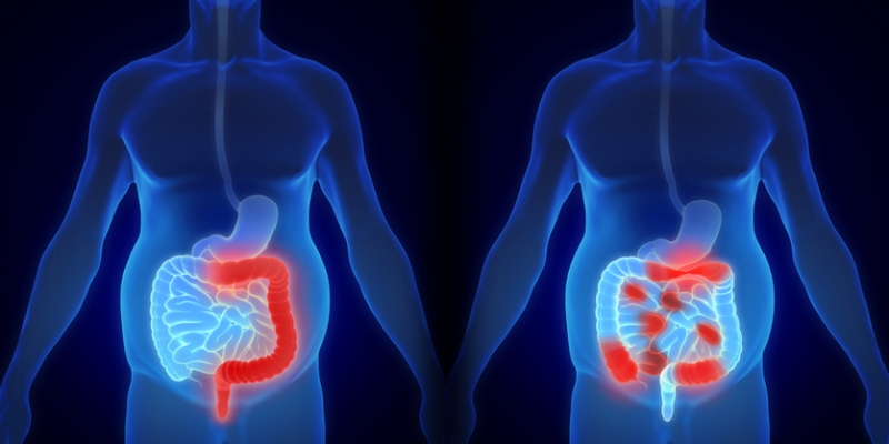 Άγχος και κατάθλιψη φέρνουν η νόσος Crohn και η ελκώδης κολίτιδα