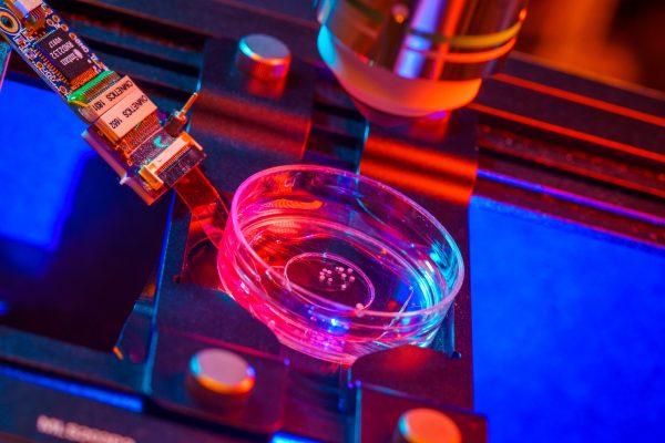 Πάρκινσον: Ενθαρρυντικά αποτελέσματα από θεραπεία βλαστοκυττάρων της Bayer