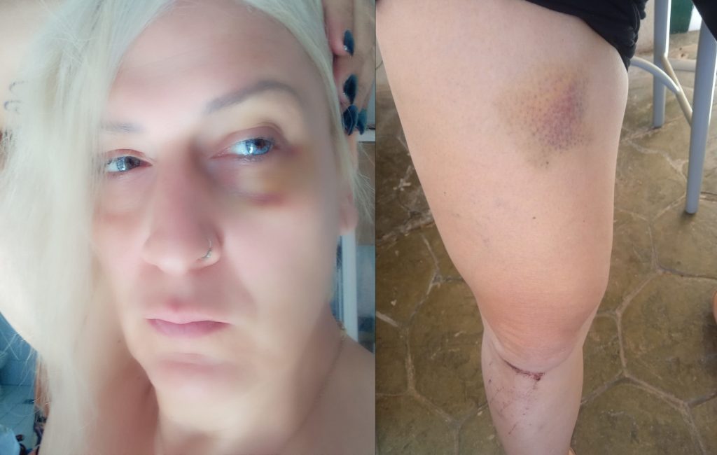 Άγρια τρανσφοβική επίθεση στο κέντρο της Αθήνας – «14 άτομα με χτυπούσαν με λύσσα»