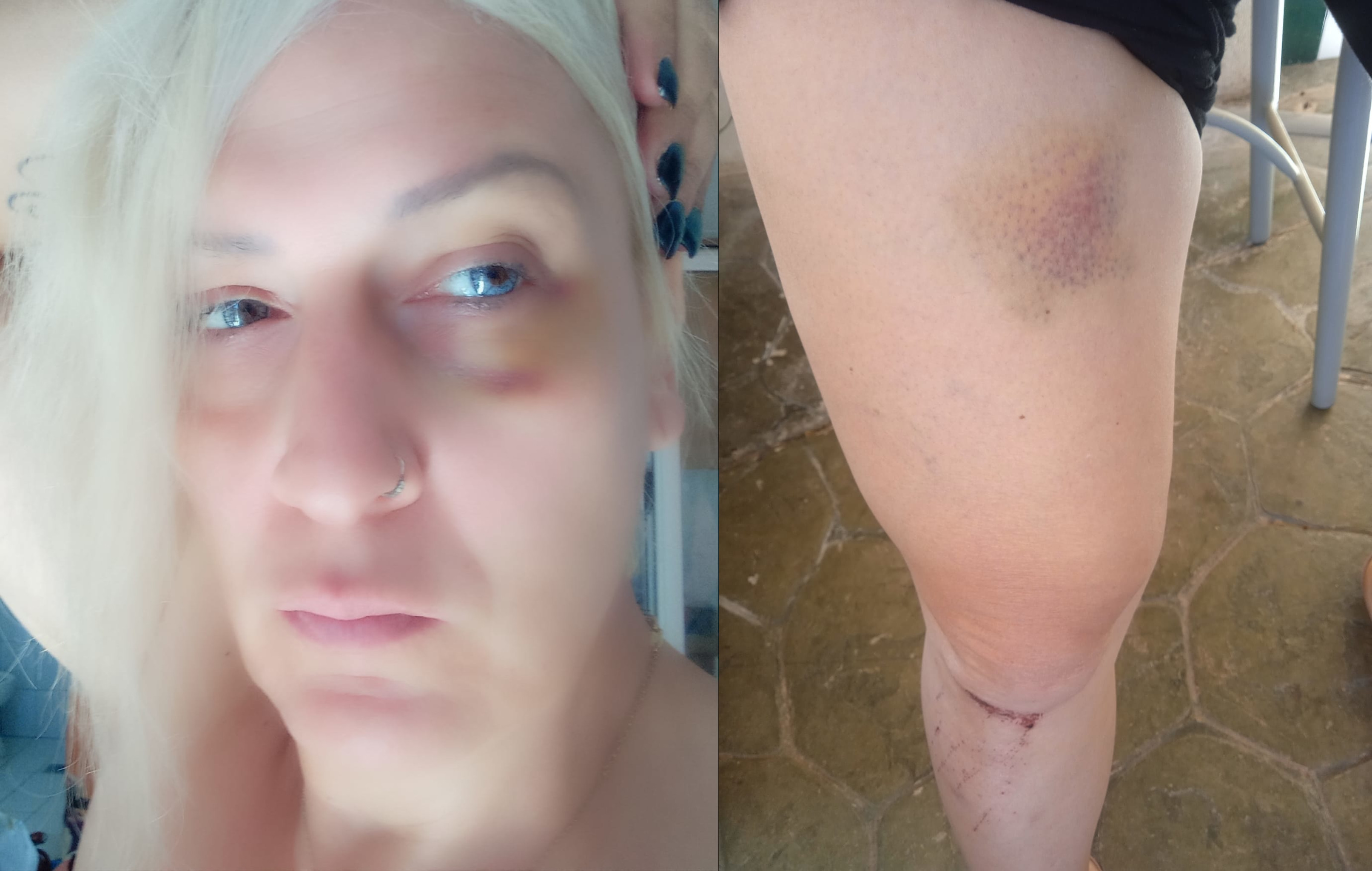Άγρια τρανσφοβική επίθεση στο κέντρο της Αθήνας - «14 άτομα με χτυπούσαν με λύσσα»
