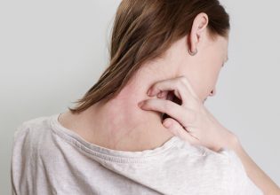 Ψωρίαση: Ο καλοκαιρινός ήλιος βοηθά – Προσοχή στο έγκαυμα