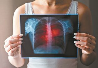 Καρκίνος του πνεύμονα: Πρωτοποριακό χάπι μειώνει τον κίνδυνο θανάτου στο μισό