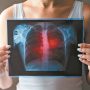 Καρκίνος του πνεύμονα: Πρωτοποριακό χάπι μειώνει τον κίνδυνο θανάτου στο μισό