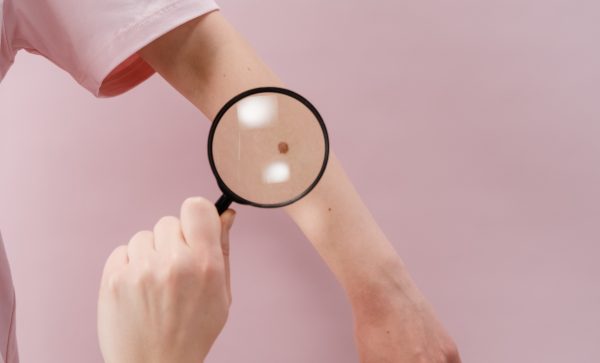 Οι μισοί και πλέον καρκίνοι δέρματος μπορούν να προληφθούν