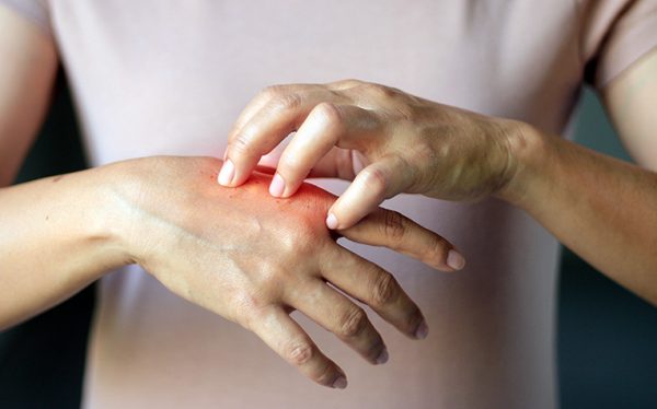 Σκληρόδερμα: Καθυστερημένη διάγνωση για το 53% των ασθενών