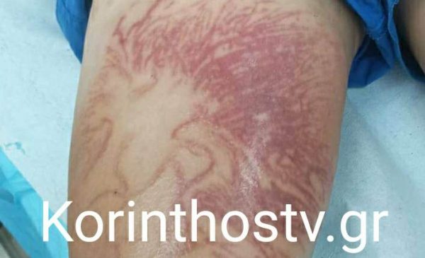 Στο νοσοκομείο 9χρονος που τον τσίμπησε θαλάσσια ανεμώνη – Βγήκε από τη θάλασσα με αφόρητους πόνους