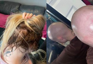Γυναίκα αναγκάστηκε να ξυρίσει το κεφάλι της λόγω extensions – «Αιμορραγούσα και έβγαζα φουσκάλες»