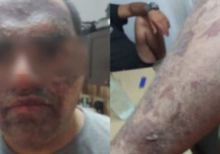 «Δεν έχει γίνει το παραμικρό» – Αδιαφορία καταγγέλλει η οικογένεια του 22χρονου εγκαυματία στην Κρήτη