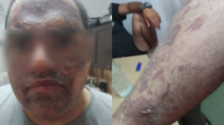 «Δεν έχει γίνει το παραμικρό» – Αδιαφορία καταγγέλλει η οικογένεια του 22χρονου εγκαυματία στην Κρήτη