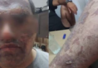 Κρήτη: Στην επιθεώρηση εργασίας ο ανασφάλιστος σεφ που κάηκε με λάδι