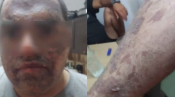 «Το παιδί έπαθε πανικό, φώναζε, δεν άντεχε τους πόνους…» – Ξεσπά η μητέρα του μάγειρα που κάηκε από καυτό λάδι