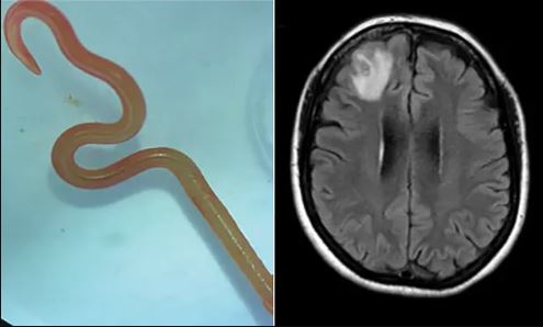 Σκουλήκι 8 εκατοστών αφαιρέθηκε από τον εγκέφαλο γυναίκας