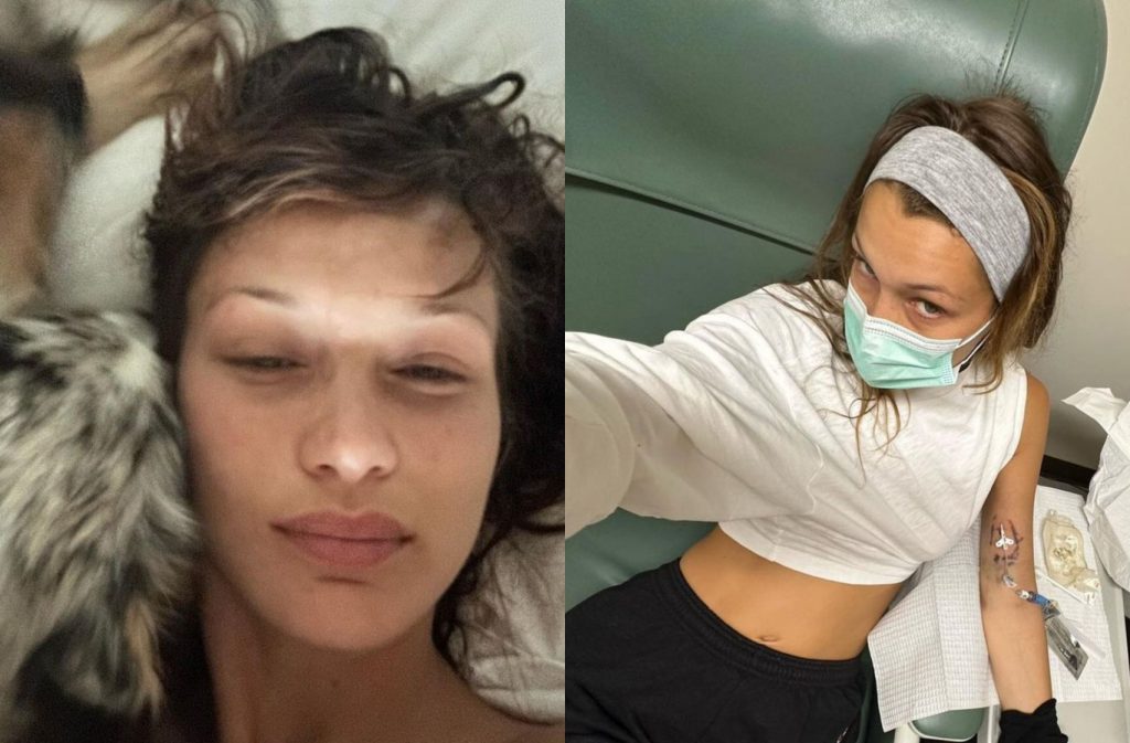 Μπέλα Χαντίντ: Νέες φωτογραφίες από τη θεραπεία της – «Αγνώριστο» το μοντέλο