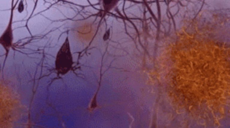 Εξέταση αίματος διαπιστώνει την Αλτσχάιμερ με ακρίβεια