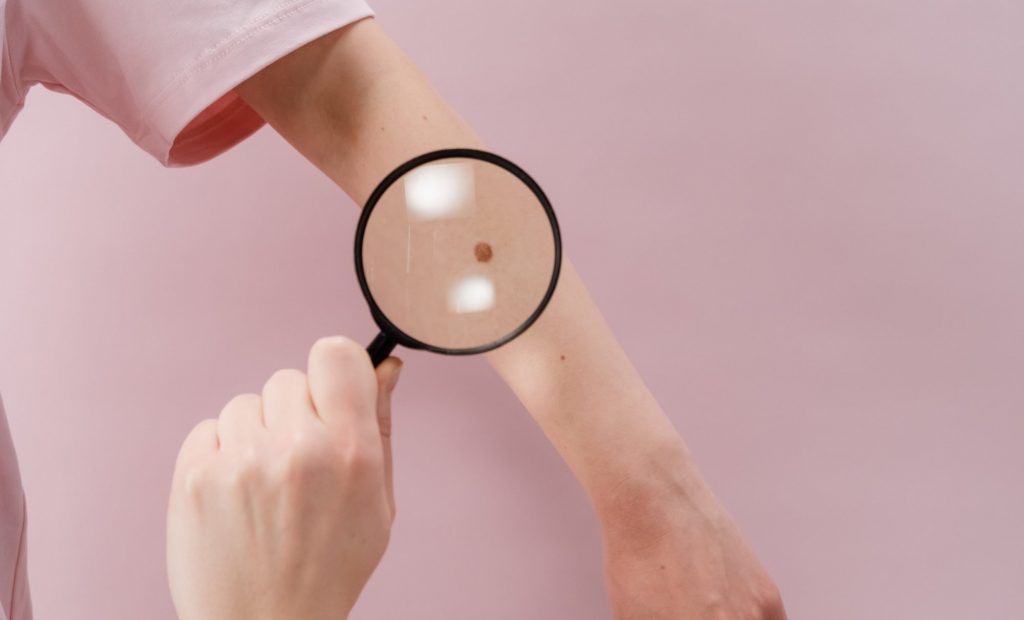 Έγκριση ανοσοθεραπείας στην Ε.Ε. για χειρουργημένο μελάνωμα χαμηλού βαθμού