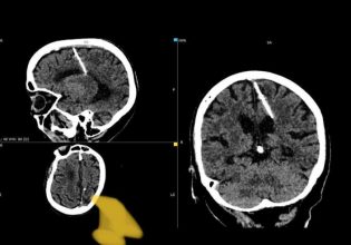 Ρωσία: Βρήκαν βελόνα στον εγκέφαλο 80χρονης – Απόδειξη ότι οι γονείς της αποπειράθηκαν να την σκοτώσουν