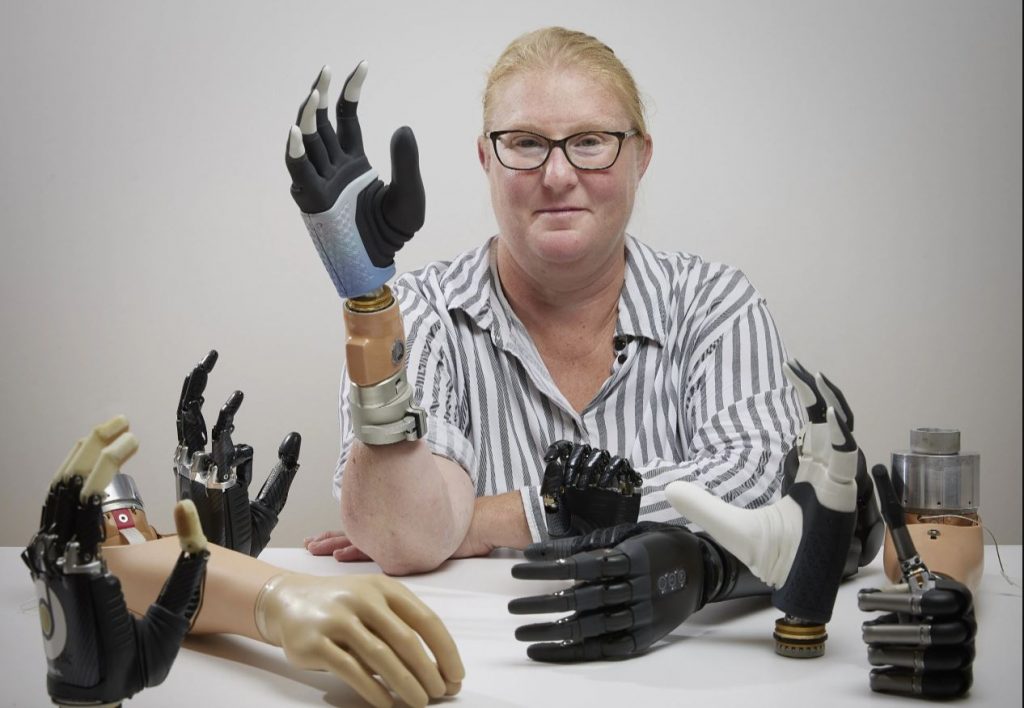 «Βιονική γυναίκα» ζει με το πρώτο ρομποτικό μέλος που συνδέεται στον σκελετό