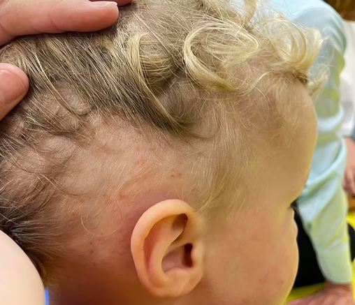 Βρετανία: «Ο γιος μου δέχτηκε εκατοντάδες τσιμπήματα από κοριούς»