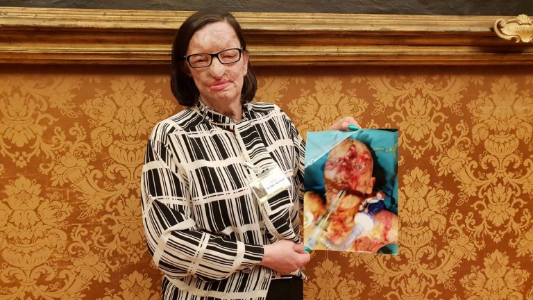 Η γυναίκα σύμβολο κατά της έμφυλης βίας στην Ιταλία που δέχτηκε επίθεση με οξύ