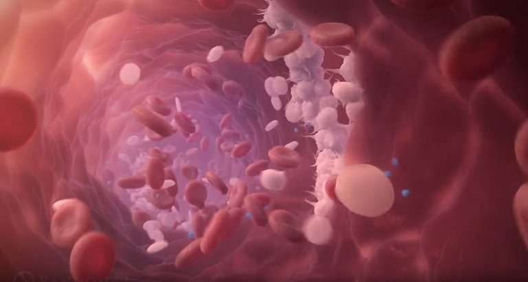 Το 80% των ασθενών δεν καταφέρνει να «ρίξει» τη χοληστερίνη