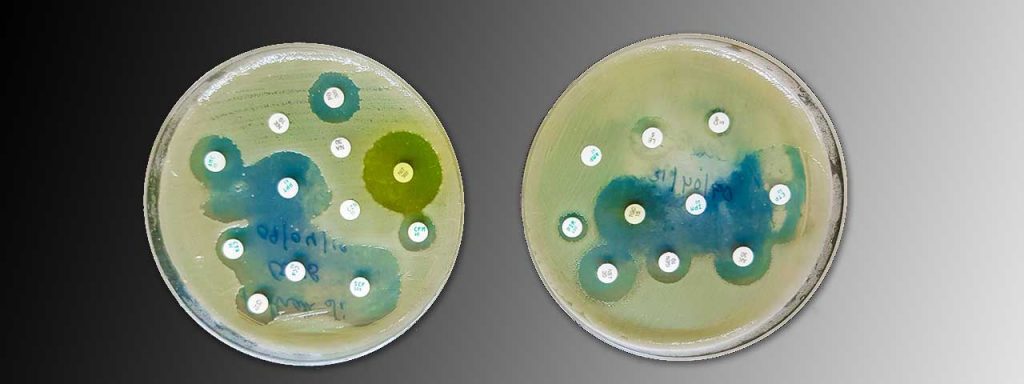 Πολυανθεκτικό μικρόβιο σε ελληνικά νοσοκομεία - Σήμα κινδύνου