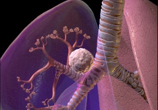 Στίγμα ο καρκίνος του πνεύμονα λόγω καπνίσματος