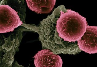 Δραστικές βελτιώσεις για τον καρκίνο χρειάζεται το σύστημα υγείας