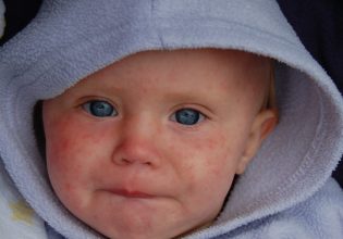 Επιδημίες ιλαράς σε 37 χώρες το 2022 – Η μία στην Ευρώπη