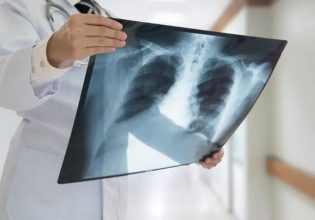 Καρκίνος του πνεύμονα: Εντοπίστηκε άγνωστο μοριακό μονοπάτι για την αναχαίτισή του