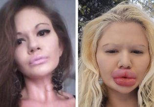 Έχει λιώσει στις πλαστικές – Έχει τα μεγαλύτερη χείλη του κόσμου και συνεχίζει