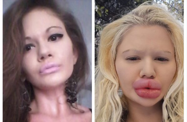 Έχει λιώσει στις πλαστικές – Έχει τα μεγαλύτερη χείλη του κόσμου και συνεχίζει