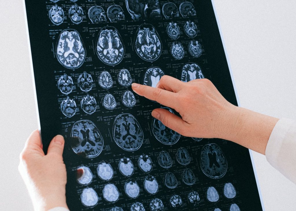 Εγκεφαλικό: Υποσχόμενη πειραματική θεραπεία αποκαθιστά τη λειτουργικότητα