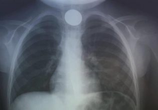 Ηράκλειο: Τρομακτική περιπέτεια για 4χρονο αγοράκι – Κατάπιε κέρμα και βρέθηκε στο νοσοκομείο