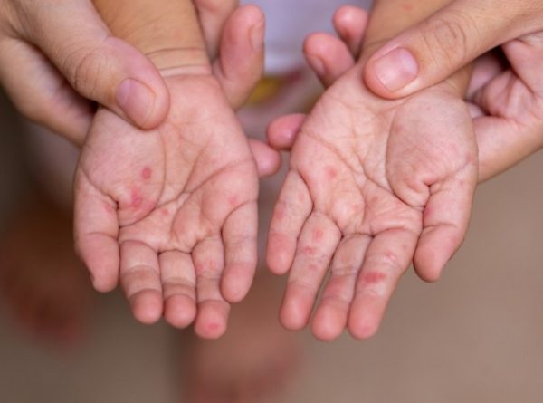 Βρετανία: Η χώρα αντιμετωπίζει αύξηση των κρουσμάτων ιλαράς