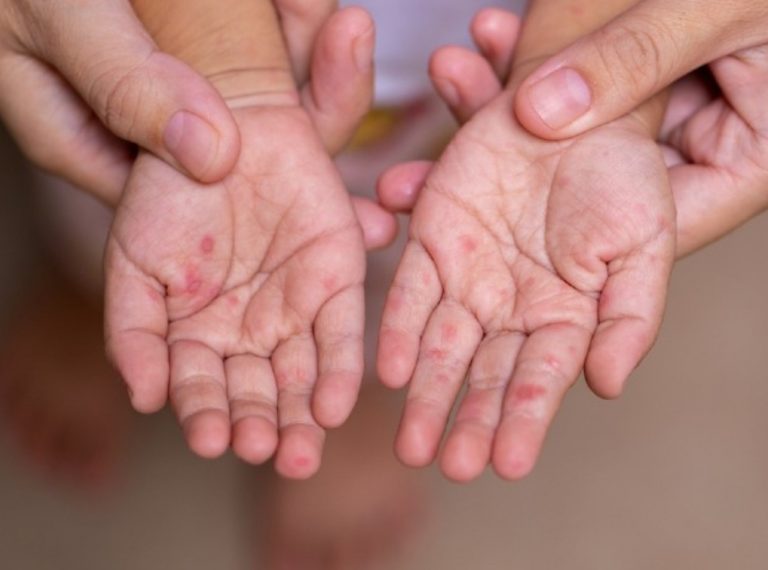 Βρετανία: Η χώρα αντιμετωπίζει αύξηση των κρουσμάτων ιλαράς