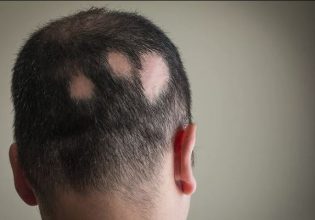 Γυροειδής αλωπεκία, ακόμα μια πιθανή παρενέργεια του κορονοϊού