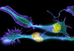Σκλήρυνση κατά πλάκας: Αρχαίο DNA αποκαλύπτει το λόγο για τα υψηλά ποσοστά στην Ευρώπη