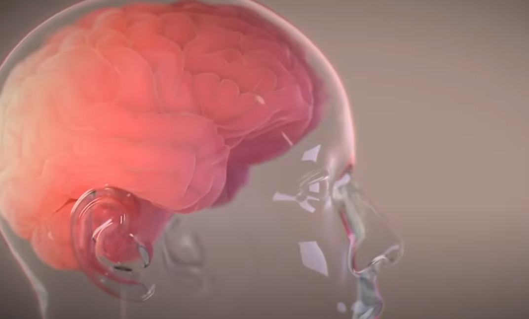 Ο Μασκ ανακοίνωσε την πρώτη επιτυχή εμφύτευση του Telepathy σε εγκέφαλο ασθενή