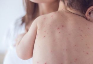 Ιλαρά: Σε έξαρση τα κρούσματα στην Ελλάδα – Ποιοι είναι πιθανό να νοσήσουν, οι επιπτώσεις στην υγεία τους